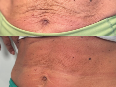 BioStimulator, Scultra stomach injections, improving skin laxity.