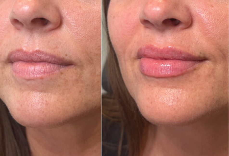 Lip Filler Before and After, Aesthetic Services